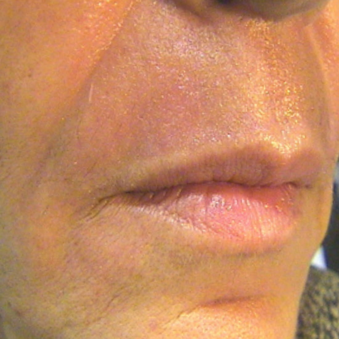 coolpeel sheffield laser treatment
