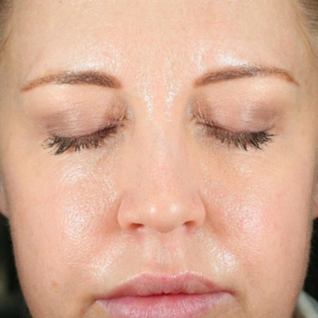 coolpeel sheffield laser treatment