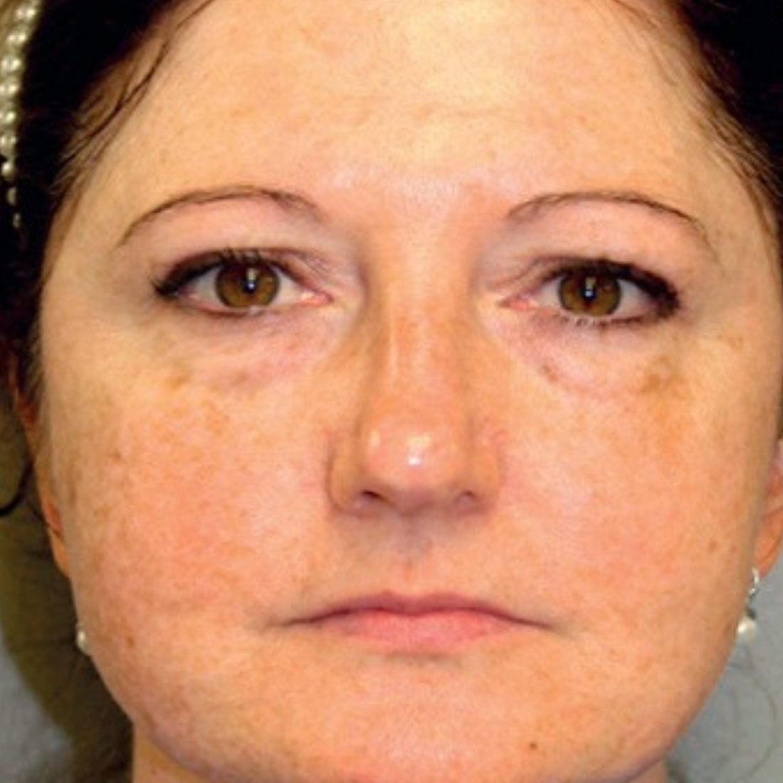 coolpeel sheffield laser treatment