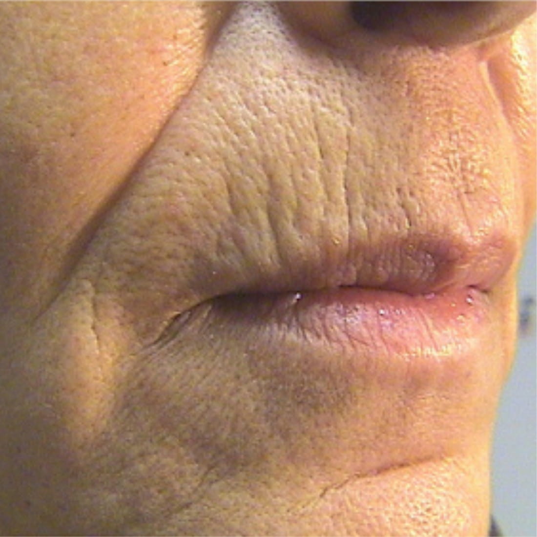 coolpeel sheffield laser treatment