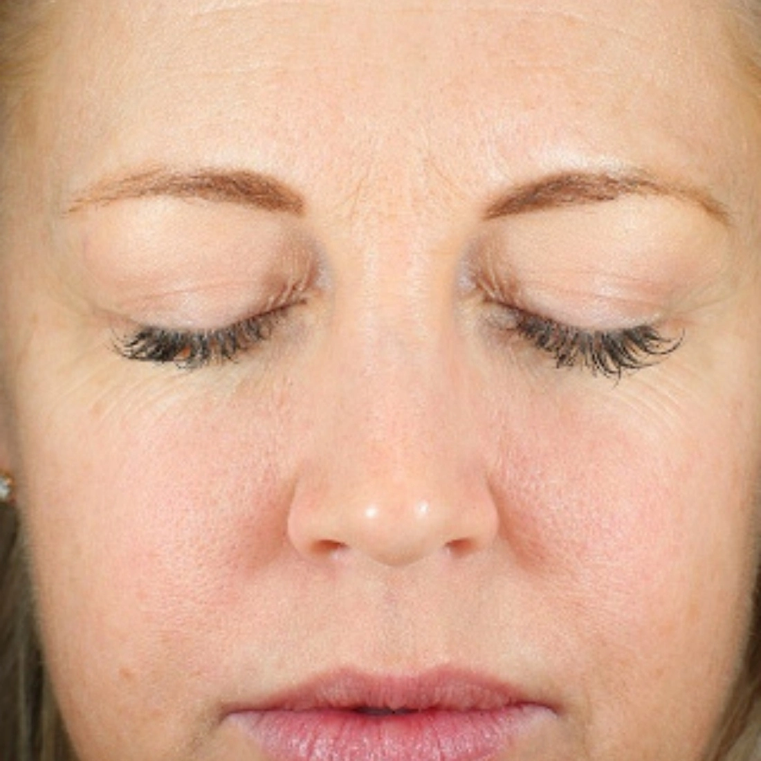 coolpeel sheffield laser treatment